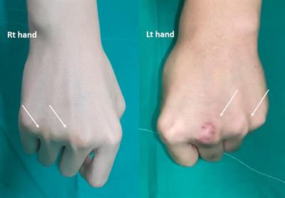 Treatment of bilateral congenital extensor tendon dislocation on multiple digits with only one sagittal band reconstruction: a case report